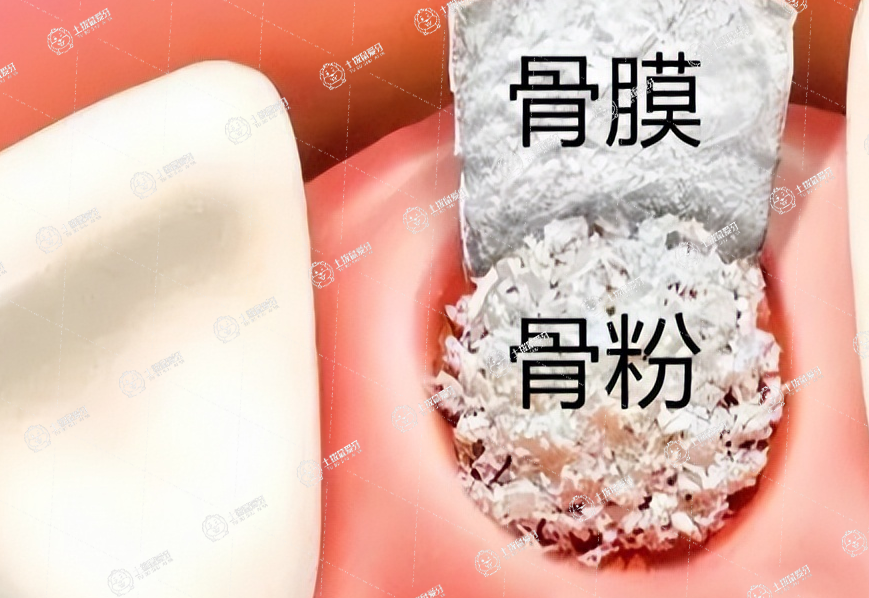 種植牙植骨粉注意事項(xiàng)