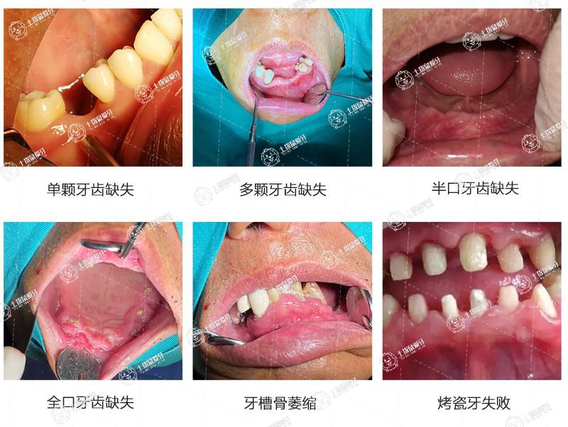 種植牙手術(shù)后疼痛難忍正常嗎
