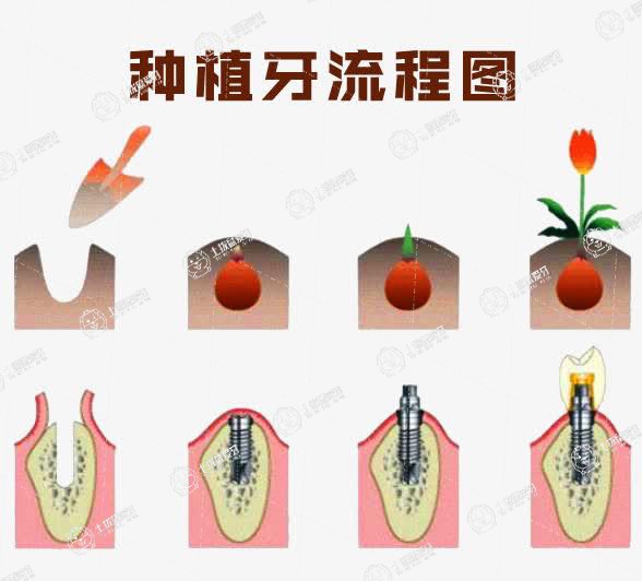 門牙種植牙牢固嗎