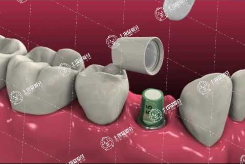 種植牙多久可以少量抽煙