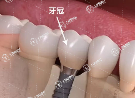 種植牙二期手術(shù)疼多久 種牙第二期安裝基臺要縫針嗎