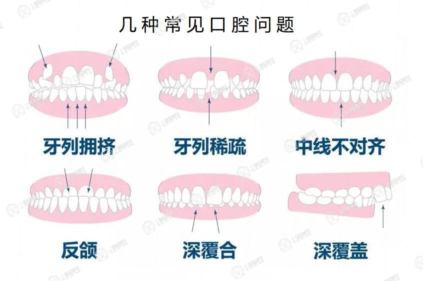 幾種常見(jiàn)的口腔問(wèn)題