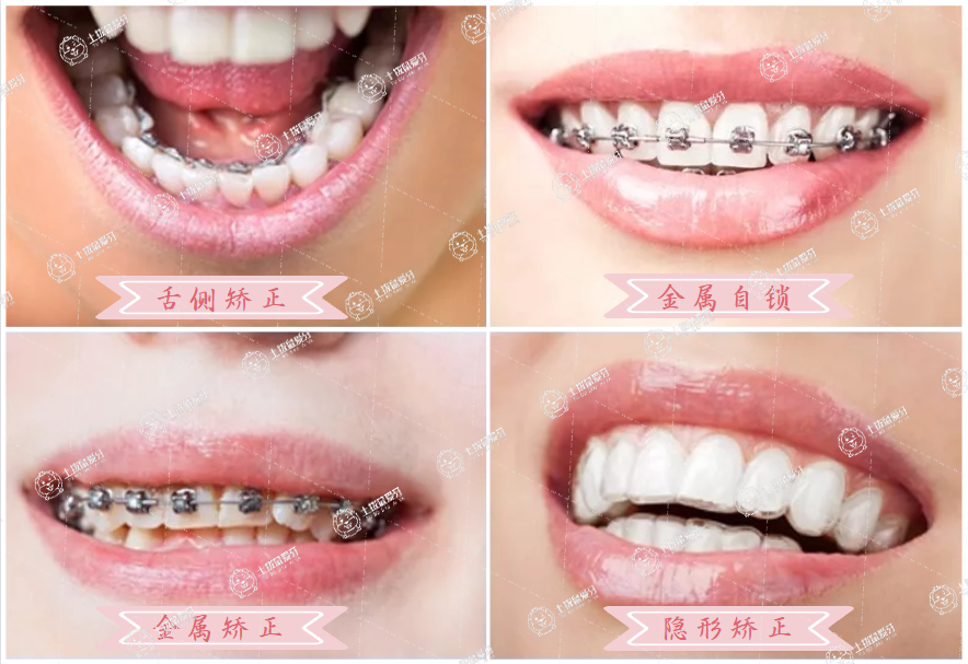 常見(jiàn)的矯正牙套