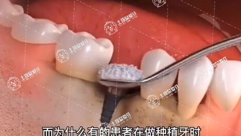 人工種植牙一般多少錢