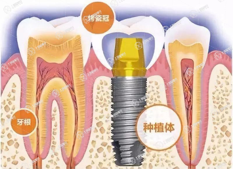 種植牙什么品牌好點(diǎn)