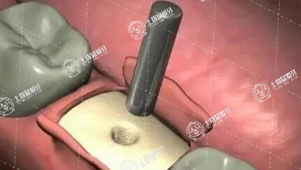 種植牙骨粉漏了嚴(yán)重嗎