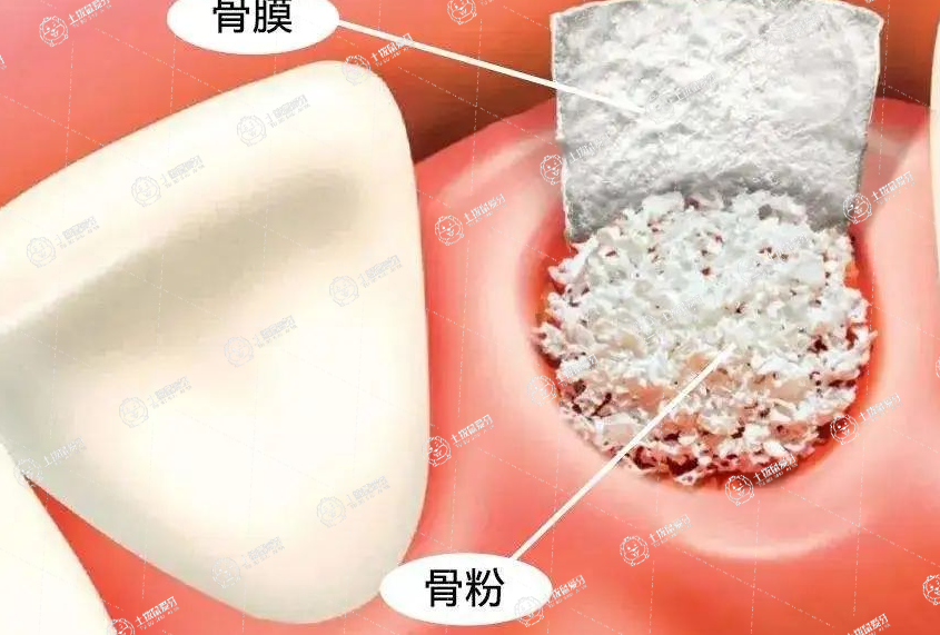 種植牙骨粉價格