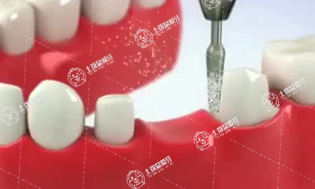 全口種植牙齒怎么樣