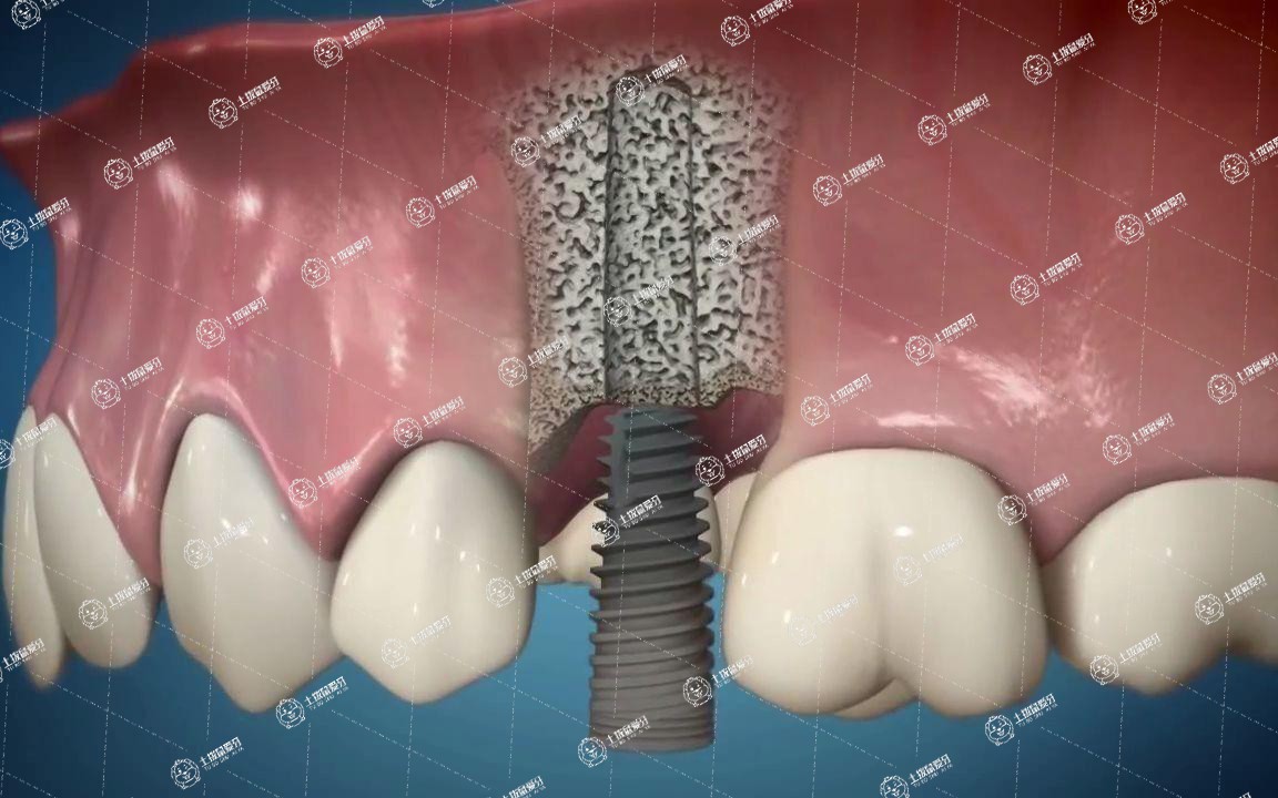 半口牙種植需要怎么護(hù)理