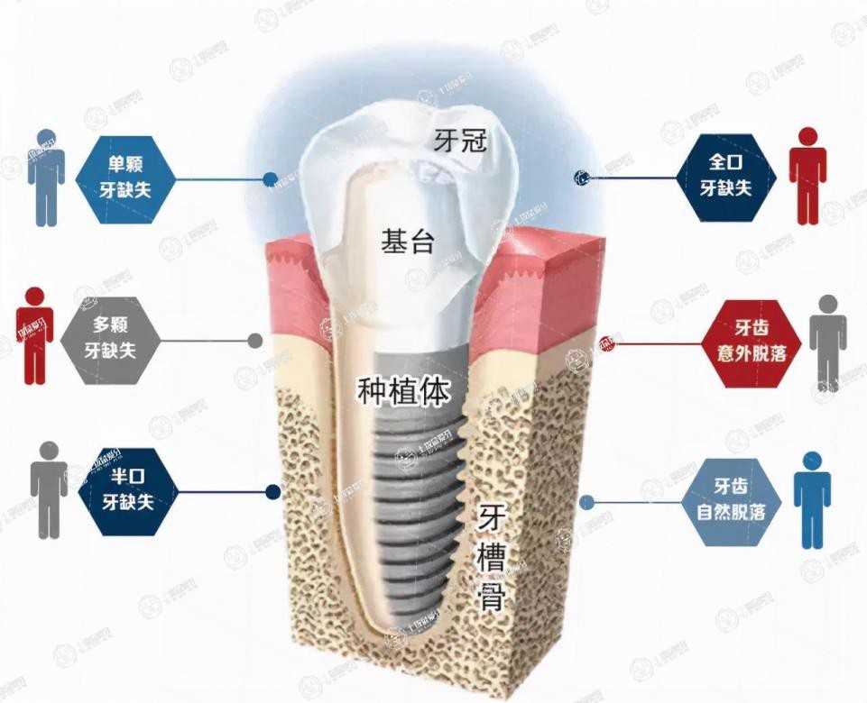 種植牙基臺和牙冠怎么固定