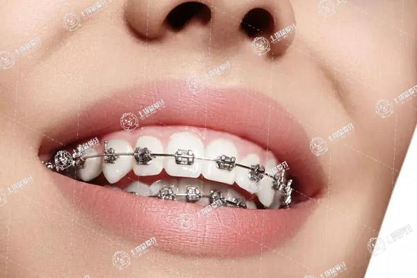 牙齒稀疏矯正方法