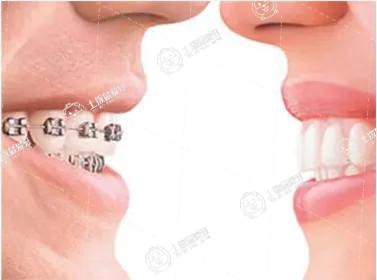 牙齒稀疏矯正方法