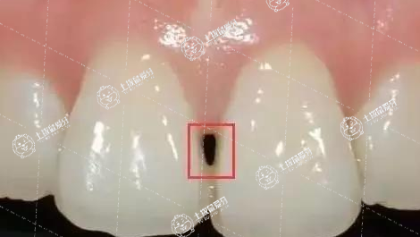 矯正牙齒出現(xiàn)黑三角怎么辦