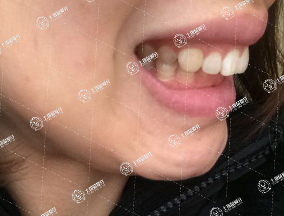 兒童牙齒深覆合需要矯正嗎