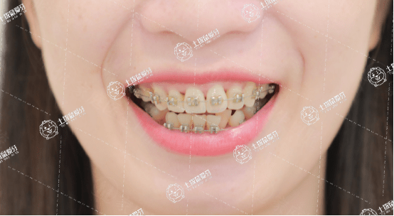 成人牙齒深覆合有必要矯正嗎