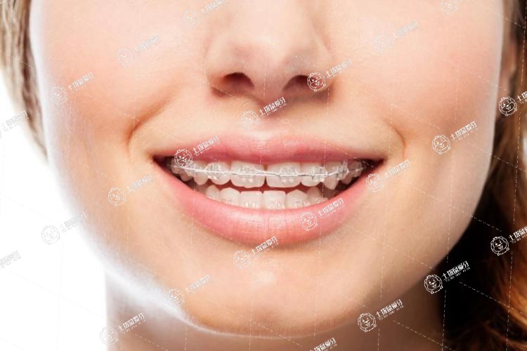 牙齒縫隙大矯正需要多長(zhǎng)時(shí)間
