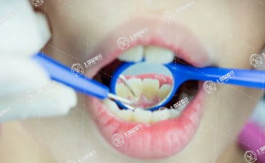 矯正牙齒深覆合怎么調(diào)整