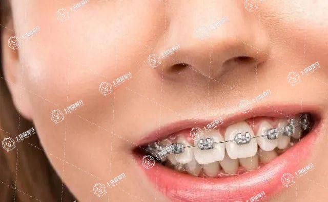 矯正牙齒深覆合怎么調(diào)整