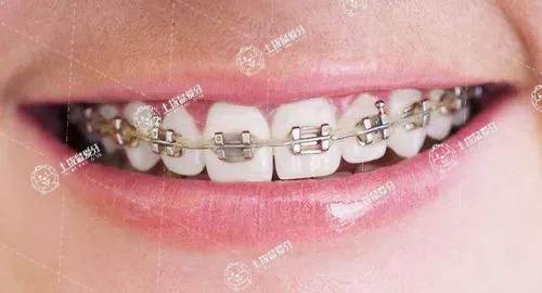 矯正牙齒深覆合怎么調(diào)整