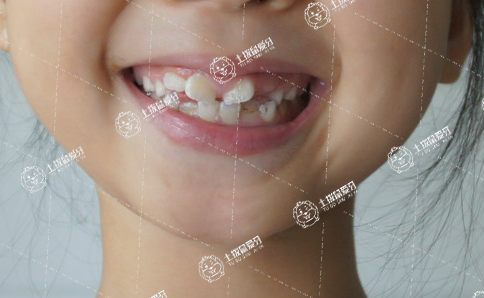 小孩牙齒稀疏牙縫大怎么矯正