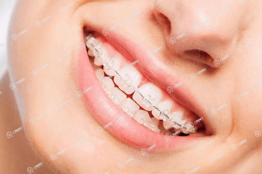 矯正牙齒費(fèi)用一般要多少錢