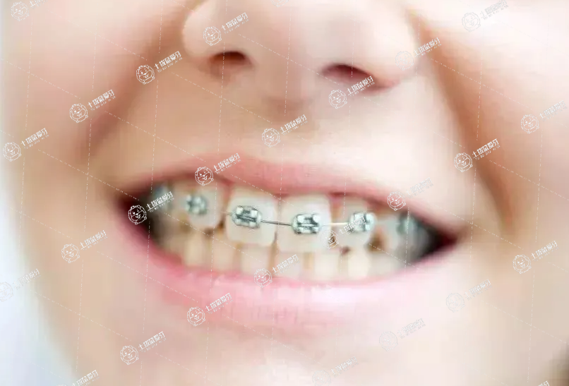 早期牙齒矯正方案