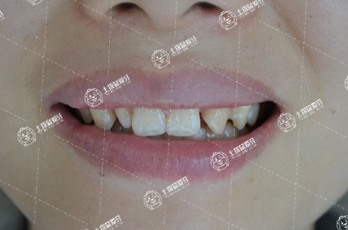 牙齒稀矯正會(huì)不會(huì)反彈