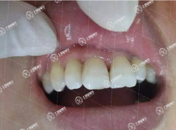 矯正牙齒出現(xiàn)黑三角正常嗎