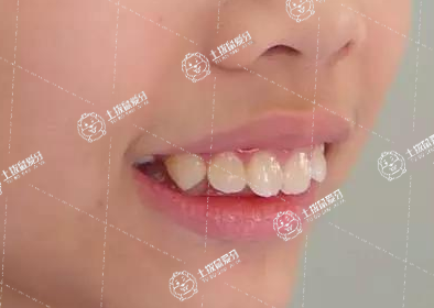 牙齒稀疏矯正周期多久