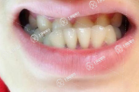 孩子牙齒地包天什么時候開始矯正