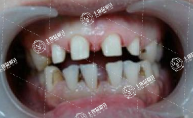 門牙牙縫大怎么矯正
