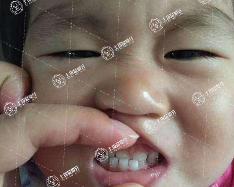 孩子牙齒地包天什么時(shí)候開始矯正
