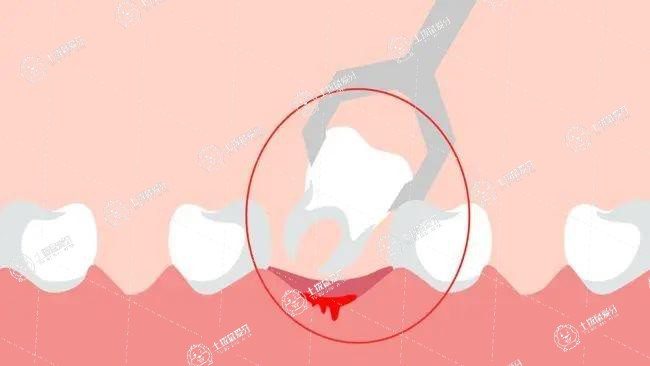 拔智齒矯正牙齒可以改善凸嘴嗎