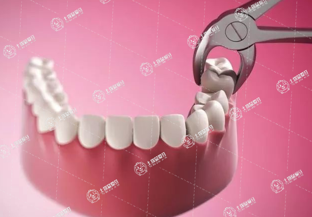 牙齒矯正一定要拔智齒嗎
