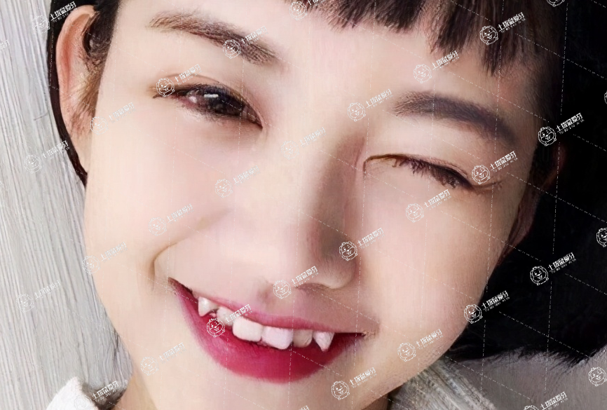 孩子虎牙長(zhǎng)在牙齦上可以矯正嗎