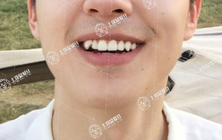 孩子虎牙長(zhǎng)在牙齦上可以矯正嗎
