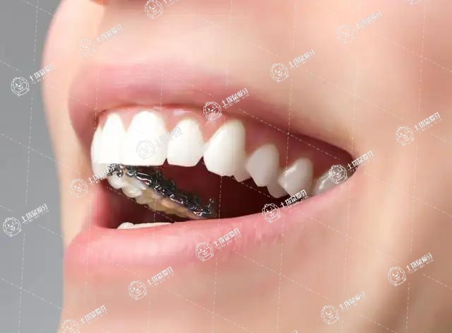 兒童早期矯正牙齒有什么好處
