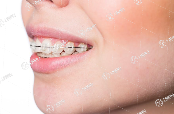 兒童早期矯正牙齒有什么好處