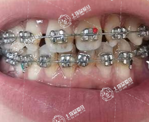 牙齒稀疏矯正牙齒大概多少錢
