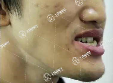 小孩牙齒地包天怎么辦