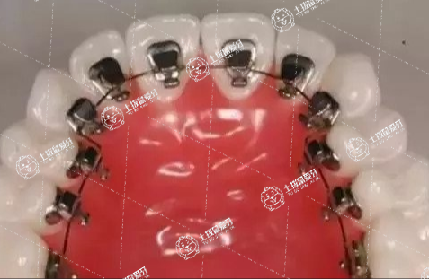 矯正牙齒會使牙齒松動嗎