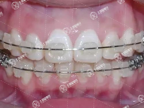 矯正牙齒擁擠多少錢(qián)