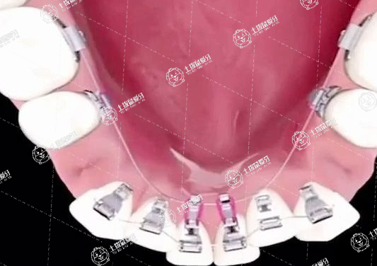 牙齒矯正要帶多久牙套