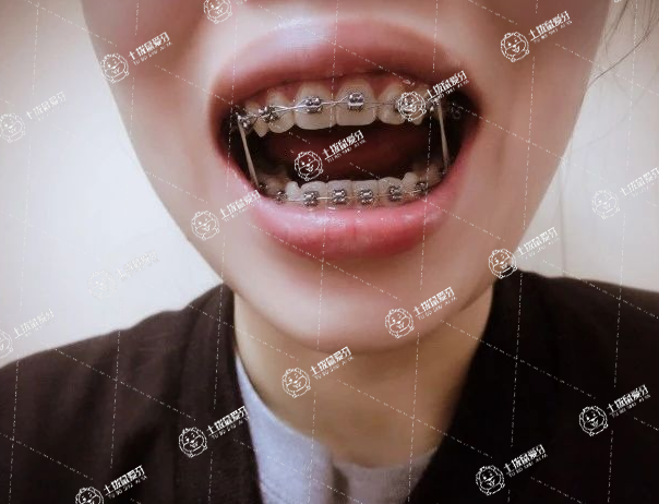 牙齒深覆合有必要矯正嗎