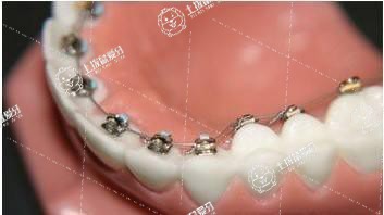 矯正牙齒擁擠方案有哪些
