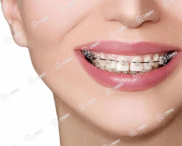 牙齒稀疏牙縫大可以只矯正上牙嗎