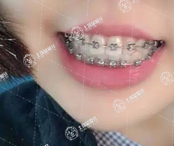 小孩子牙齒地包天需要矯正嗎