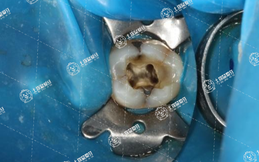根管治療后必須做牙套嗎