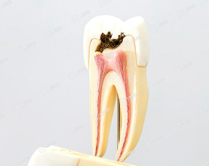 根管治療牙齒的好處和壞處