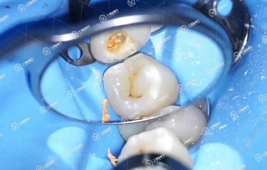 牙齒根管治療費(fèi)用一般多少錢一顆